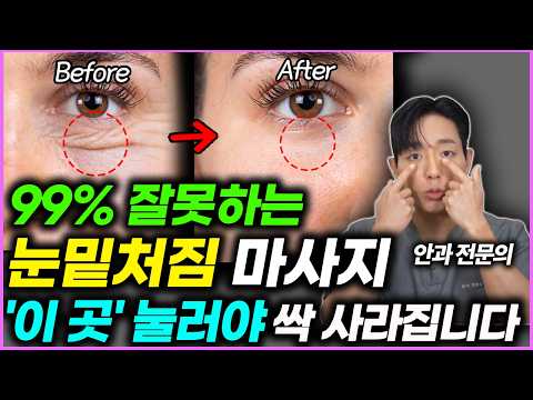 눈밑 처짐 집에서 이렇게 했더니 쉽게 없어졌다 | 눈 밑 처짐, 눈밑지방 홈케어 방법 (조성원 안과전문의 1부)