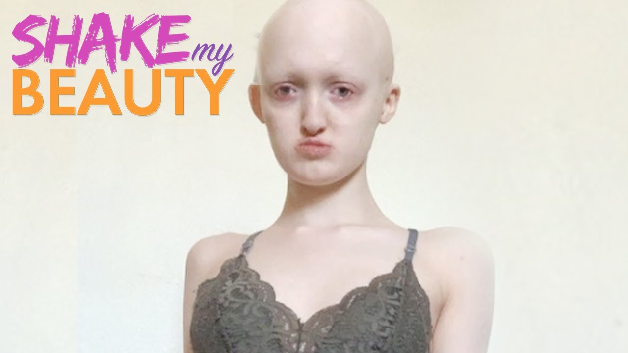 Bullied because of my rare genetic condition - shake my beauty