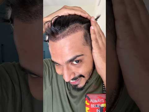 My Hair transplantation Journey🤩💇#shorts #shortsfeed #youtubeshorts #hiartransplantation
