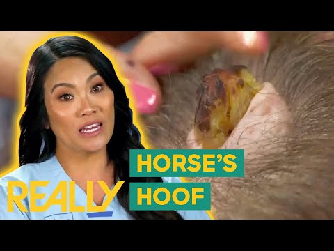 Dr. Lee Removes A “Horse's Hoof” Like Bump From Patient’s Head | Dr. Pimple Popper