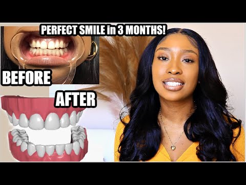 How I Fixed My Overbite & Closed Gaps in 3 MONTHS! My Invisible Braces Journey BEFORE & AFTER Byte