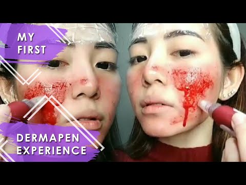 DERMAPEN SAMPAI BERDARAH UNTUK MENGHILANGKAN BOPENG & BEKAS JERAWAT - DERMAROLLER TUTORIAL