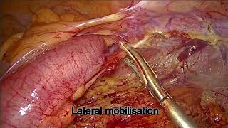 Laparoscopic Anterior Resection: Step-by-Step Surgical Technique