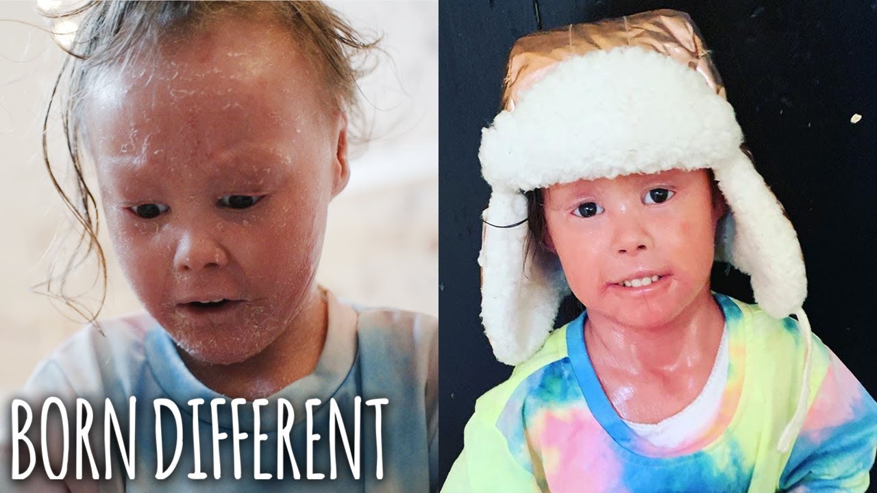 The girl whose skin grows too fast - born different