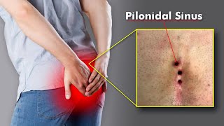 Pilonidal Sinus: The Hidden Pain Near Your Tailbone (3d animation)