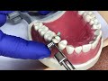 Matrix Band Procedures in Dentistry