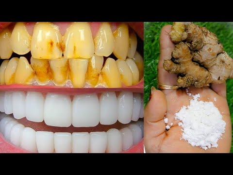 सिर्फ 2 मिनट में गंदे पीले दांतो को मोती की तरह चमका देगा यह नुस्खा Teeth Whitening Home Remedy