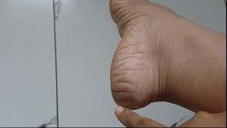 കാല് വിണ്ടു കീറുകയോ കുഴി നഖമോ ഉണ്ടെങ്കിൽ ഇങ്ങനെ ചെയ്യു