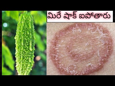 భయంకరమైన భరించలేనంత Fungal Infection ఉన్న సరే ఒక 2 రోజులు ఇది రాయండీ ఇక మీ పక్కకి కూడా రాదు