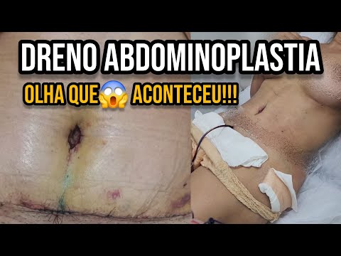 GUIA COMPLETO DRENO ABDOMINOPLASTIA: Dicas Como usar e desentupir dreno pós operatório