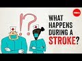 Understanding Strokes: Causes, Effects, and Treatments