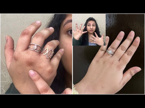 It hurts 😢Hands Cracking in Winters | Bleeding Dryness | Skin Care Doctor Dermatologist