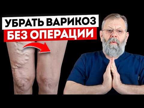 Варикоз. 5 упражнений за 7 минут. Избавление без операции.