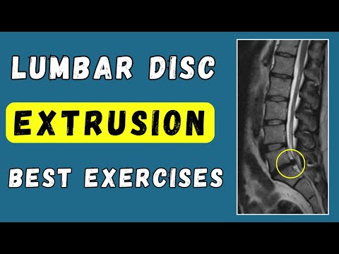 Best exercise and tips for lumbar disc extrusion recovery