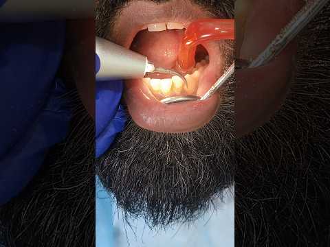 Daanto Safai Kaise Hoti Hai? |Teeth Cleaning Live On Patient 😱 #trending #youtubeshorts #shortsfeed