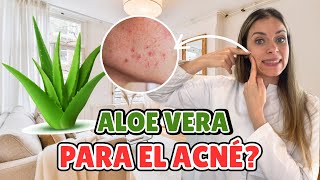 Aloe vera para el acné #acne 