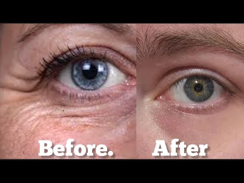 Remove under eye wrinkles look beautiful look amazing