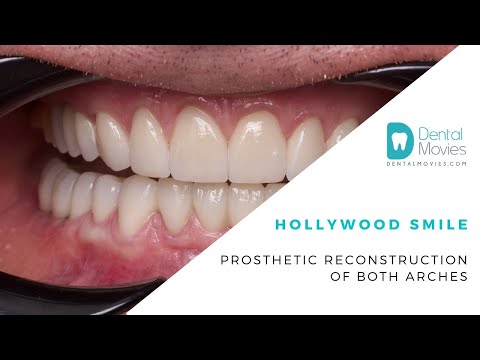 Hollywood smile - prosthetic reconstruction of both arches