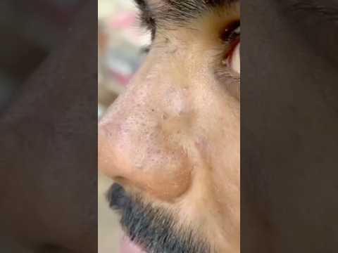 വെറും ഒരു മിനിറ്റിൽ കരിവാളിപ്പ് മാറ്റി മുഖം വെളുക്കും😱Skin whitening face pack #shorts #skincare