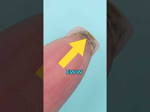 UGLYS Under Your Nail?                🤢