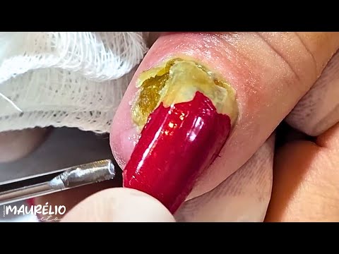 😳 INFILTRAÇÃO SEVERA #viral #satisfying