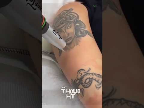 What Really Happens During Laser Tattoo Removal?                        #documentary#usashorts#fyp