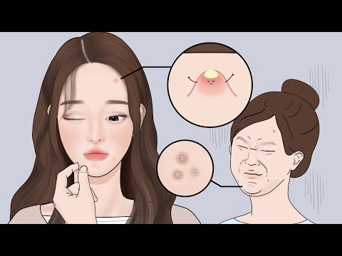여드름 피부 공감 1000% 오래가는 여드름 흉터 초기에 제대로 잡는법! with 스카덤 클리어겔