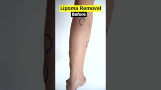 Multiple Lipoma removal | Lipoma cure #shorts