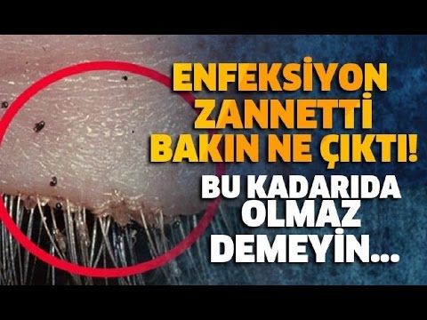 Enfeksiyon Zannetti BAKIN NE ÇIKTI !
