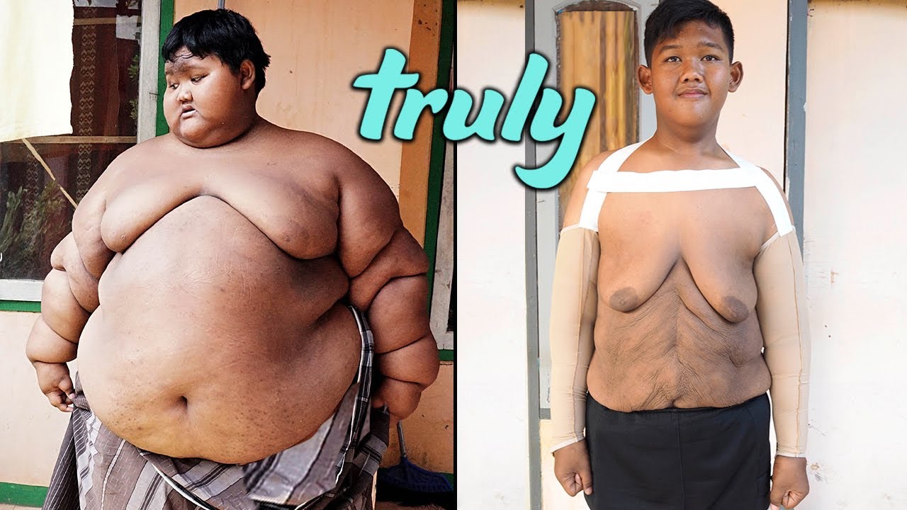 'world-s heaviest kid' has saggy skin surgery - truly
