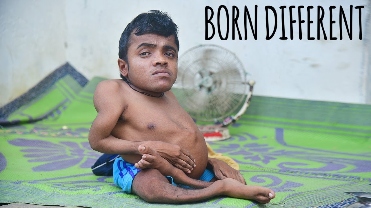 The man with bendy bones - born different