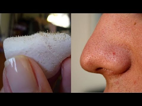 Easiest Trick To Remove Blackheads And Get Glowing Face