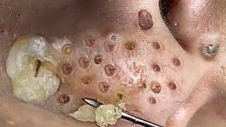 Loan Nguyen Acne Treatment 134c