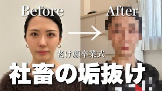 【顔面改造】脂肪吸引したら垢抜けすぎて人生変わった卍