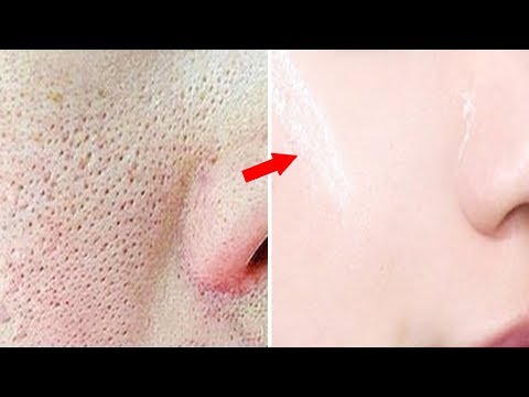 In 3 Days Get Rid of Large OPEN PORES Permanently | Get Tighten Glowing Skin