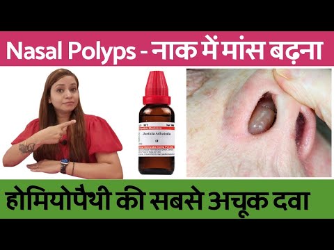 नाक में मांस बढ़ना | nasal polyps homeoapthic treatment | nasal polyps homeopathic medicine