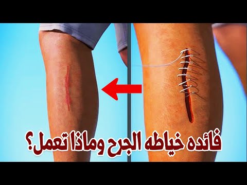 فائده خياطه الجروح وكيف تلتئم وتشفى؟