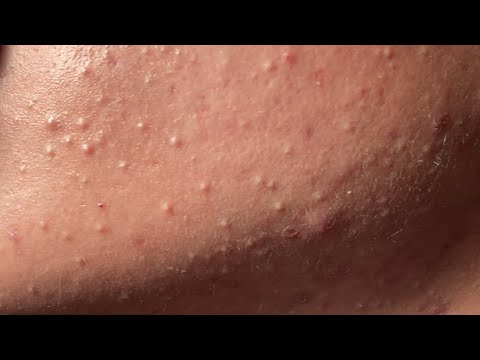 Acne Treatment Huong Da Nang# 718#Remove Hidden acne