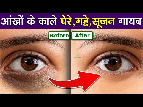 आंखों के काले घेरे गड्ढे सूजन गायब | Dark circles, puffiness and eye swelling disappear !