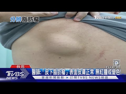 摸起來接近圓形 不痛 無紅腫「腫瘤」長在身體「這幾處」醫師:速就醫檢查判定｜十點不一樣 健康2.0 @tvbshealth20