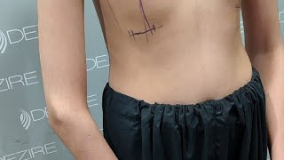 Live Breast Implant Surgery Planning