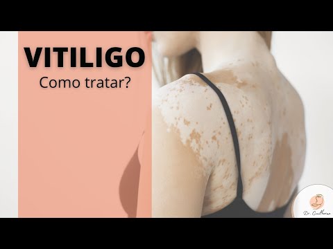 Tenho vitiligo: e agora?