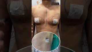 Gynecomastia | Gynecomastia Treatment