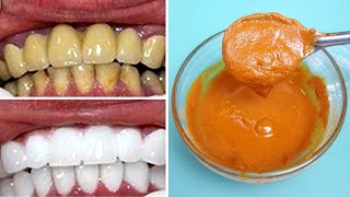En Sólo 3 Minutos Por Semana - Blanquear Los Dientes Naturalmente Con Estos 3 Ingredientes