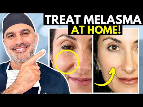What you NEED to know about treating Melasma AT HOME the RIGHT way!