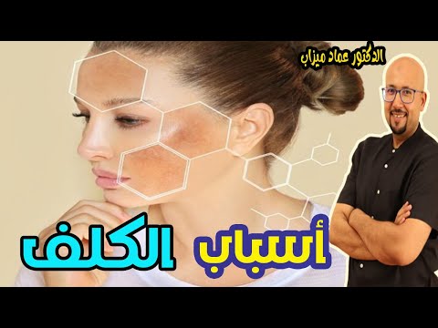 سيروم فعال ضد الكلف و ماهي أسبابه   -   الدكتورعماد ميزاب   -