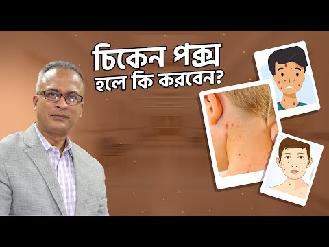 জলবসন্ত বা চিকেন পক্স কি এবং কেন হয়? চিকেন পক্স হলে কি করবেন? | Chicken Pox | DrferdousUSA |