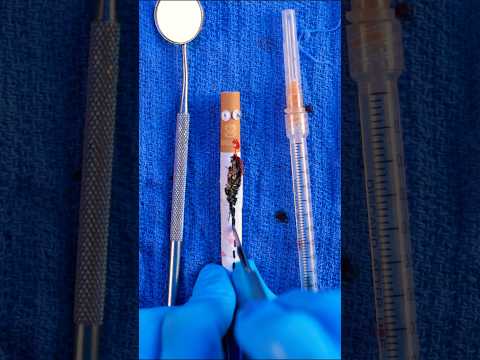 What’s inside a fake c1garette? #fruitsurgery #asmr #satisfying #DiscountDentist #FilmProps