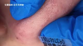 20250429飽滿的白頭粉刺whiteheads--Taiwan Yilan City-宜蘭清粉刺達人-亞芳美妍館