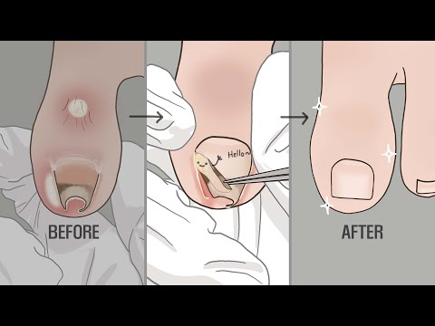 [발청소 ASMR 2탄] 눈과 귀가 시원한 내성발톱치료 애니메이션 *리얼함 주의* / LULUPANG 루루팡